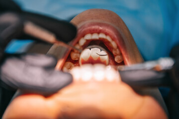 歯科インプラント手術後の生活はどうしたらいいのか