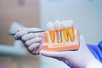 インプラント後の歯科矯正について