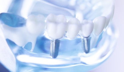 インプラント治療と歯周病について