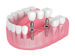 奥歯のインプラントが保険適用になるケースはあるの？
