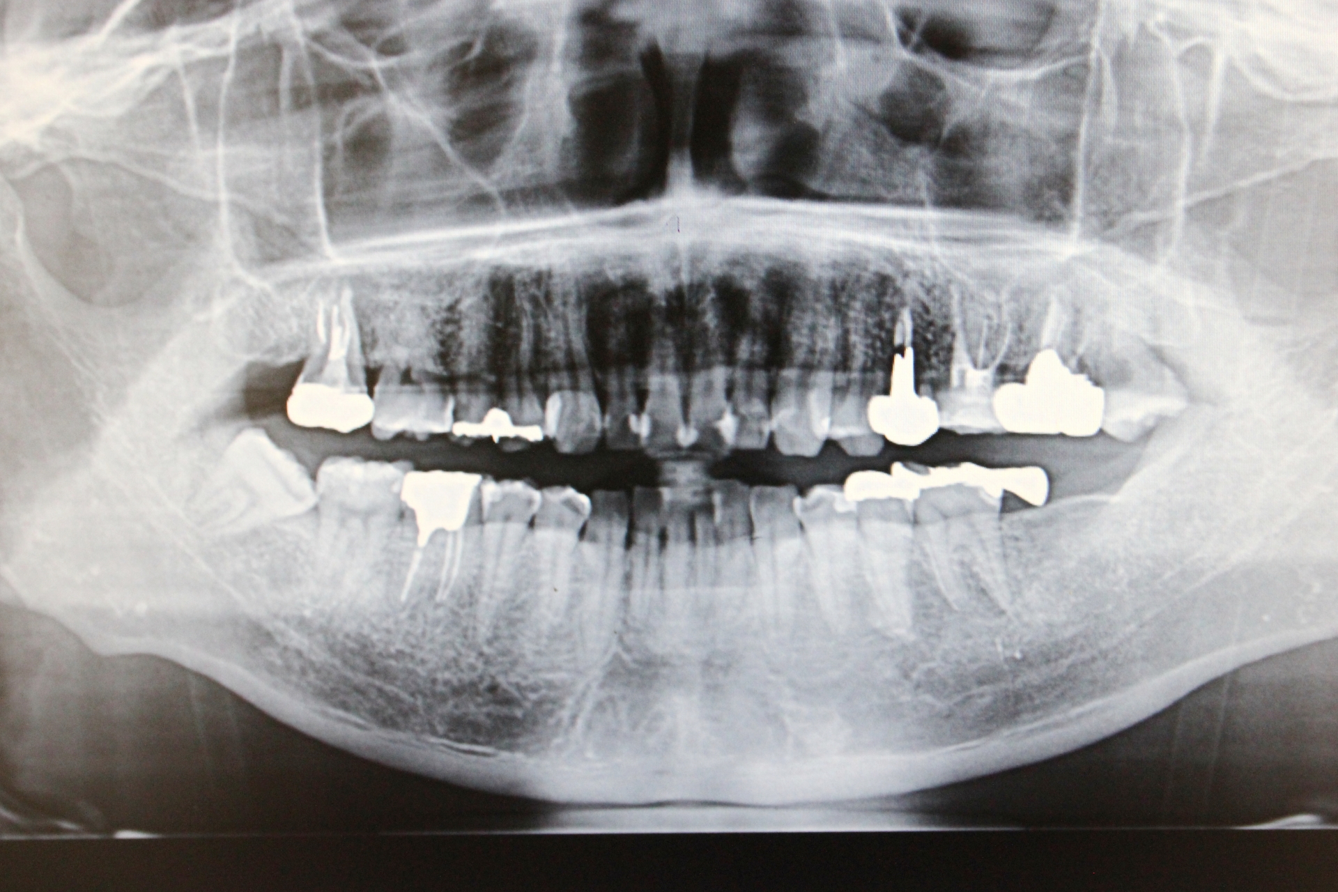 歯科用レントゲン