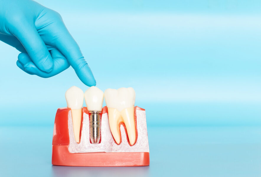 オールオン4で骨造成が必要になるケースとは？治療の流れや注意点も併せて解説