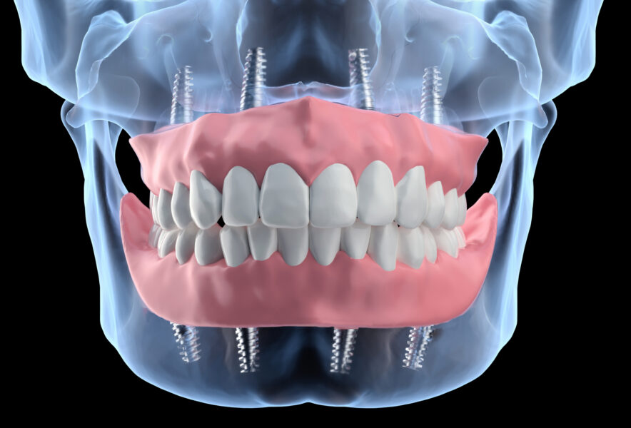 オールオン4の仮歯の役割｜手術の流れ・上部構造ができるまでの期間も解説