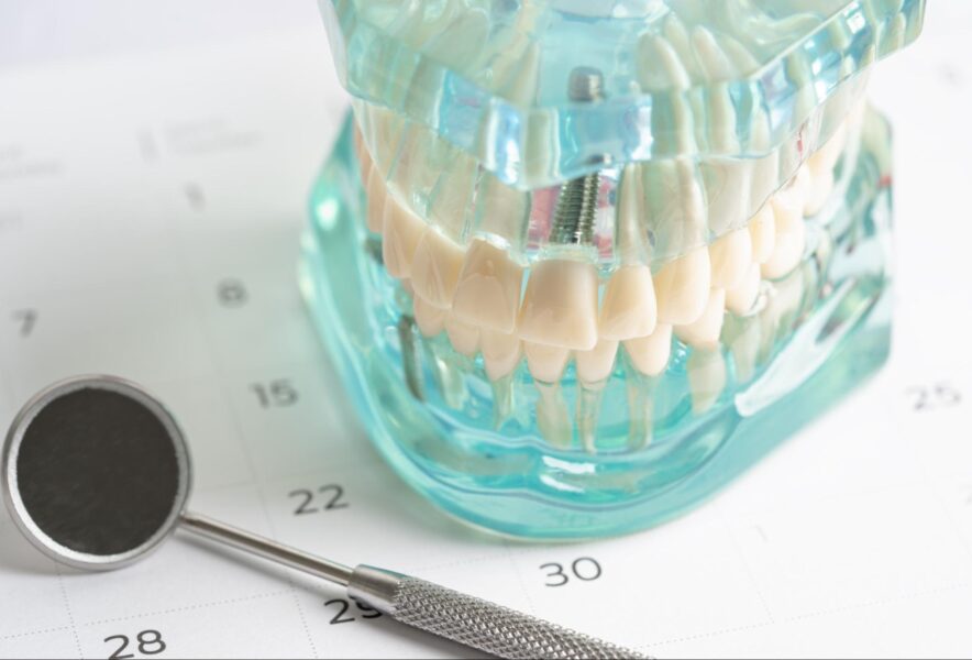 ンプラント手術後の過ごし方｜経過や注意点、普段の生活に戻るまでの流れを解説