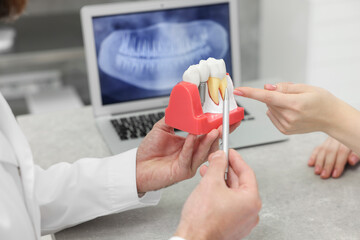 奥歯のインプラント治療について