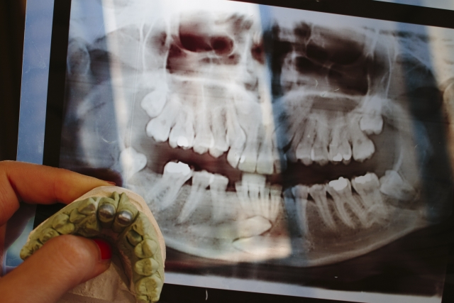 「先天性欠損歯」とは？特徴や原因、発生確率や治療方法などを詳しく解説