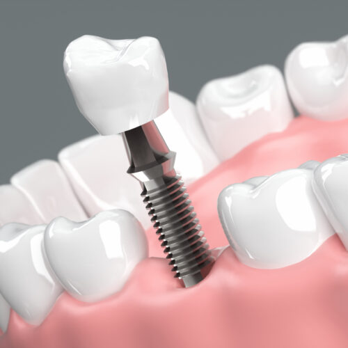 インプラント治療のストローマンとは？｜特徴・主なインプラント