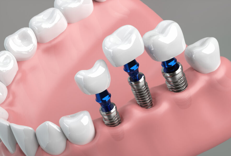 インプラント治療で歯茎が黒い色になる？原因と対処法を徹底解説