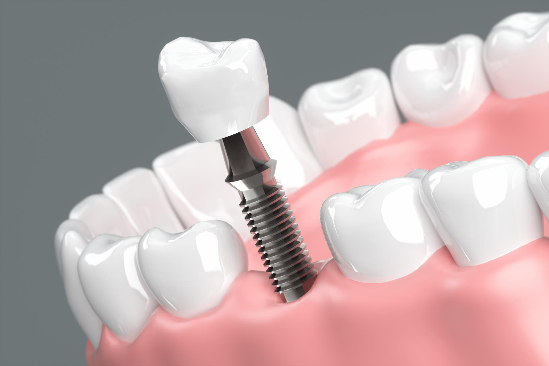 差し歯と入れ歯以外の治療法について