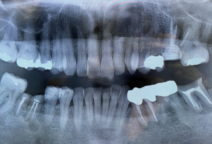 歯が欠損したらどうすれば良い？予防方法や各治療法についても解説します