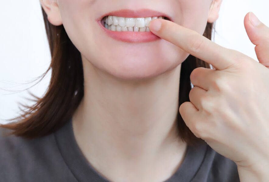 差し歯で前歯は治療できる？治療できないケースや他の治療方法も解説！