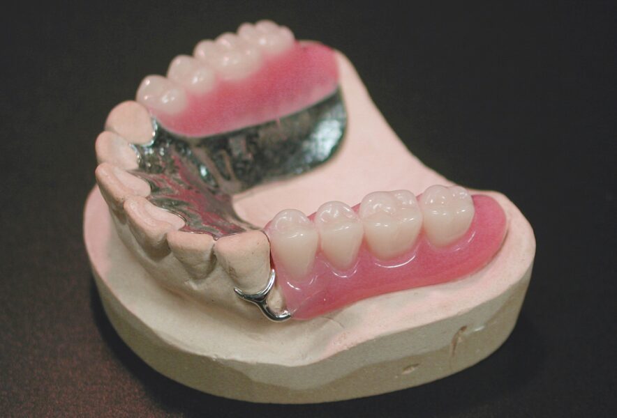 義歯の種類はいくつある？義歯を使った治療方法や治療ごとのメリット・デメリットについて解説！