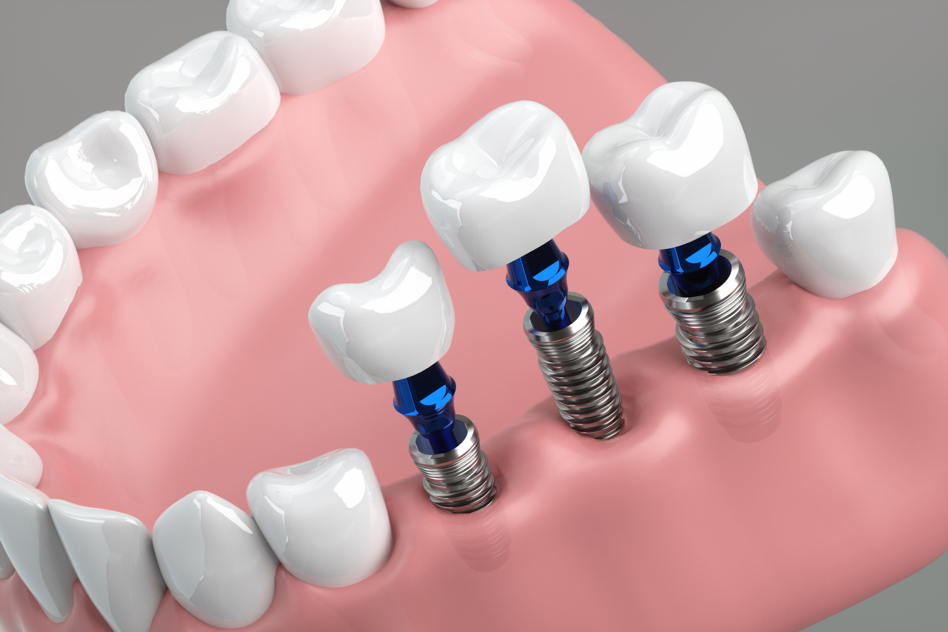 義歯（入れ歯）以外の治療方法