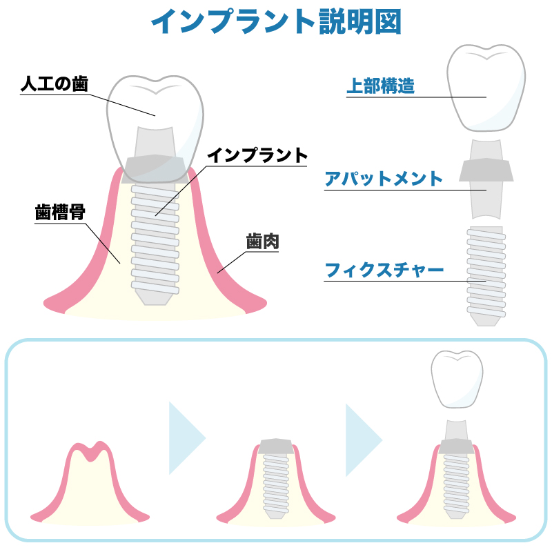 インプラントの構造