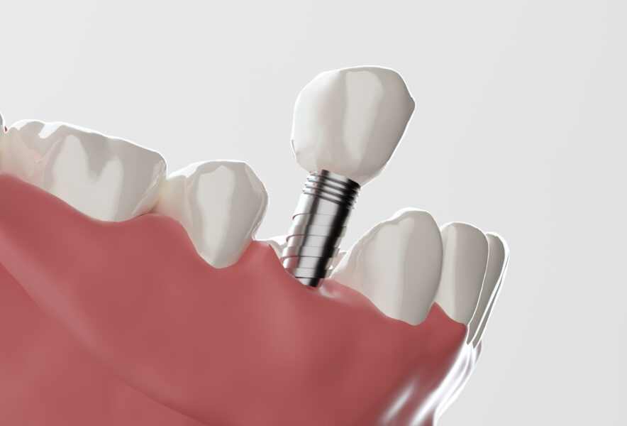 糖尿病で歯がなくてもインプラントは受けられる？知っておきたいリスクや注意点